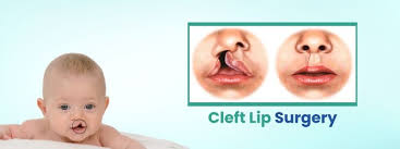cleft lip surgery cost in india mejocare
