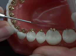 While braces are typically considered the best way to straighten teeth, not everyone likes the metallic look of traditional braces. Want Straight Teeth Without A Smile Full Of Wire Try Lingual Braces Wral Com