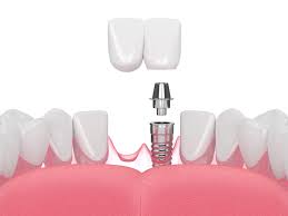 what is a dental bridge procedure