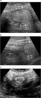 colonic lipoma causing intussusception