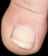 avoid ingrown toenail surgery