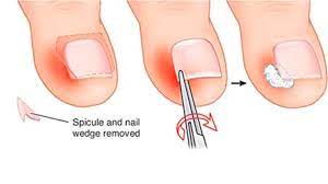 ingrown toenails specialist in nyc