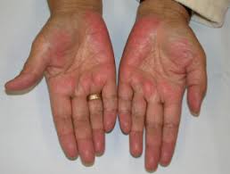 It happens whenever blood vessels in the hand become dilated. Cutaneous Adverse Effects Of Alcohol Dermnet Nz
