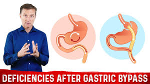 gastric byp bariatric surgery