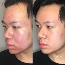 acne scar treatment removal vancouver