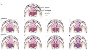 unilateral cleft of the soft palate