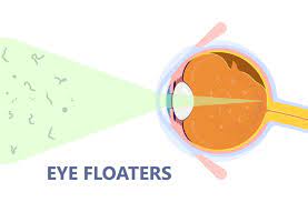 are floaters after cataract surgery