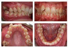Adults make up 25% of these a new option available for correcting crowded and crooked teeth is invisalign. Before And After