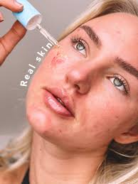 about accutane