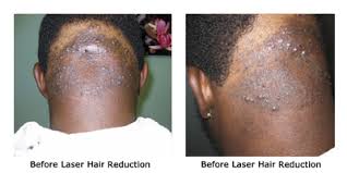 coolglide laser hair removal