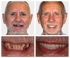 Free dental implants for low income uk. Dental Implant Treatment In Leicester Loughborough For Missing Teeth