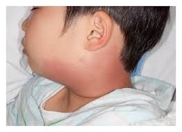 left cervical erythema and lymph