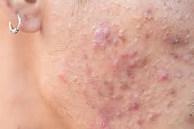 how to treat acne plus learn