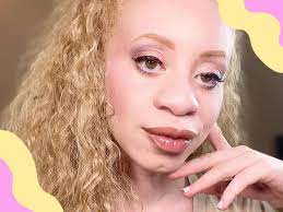 albino beauty influencer