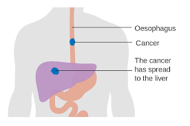Esophageal Cancer Wikipedia