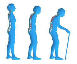 Resultado de imagen de osteoporosis