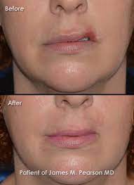 pearson lip reconstructive surgery