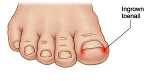 ingrown toenail removal care treaty