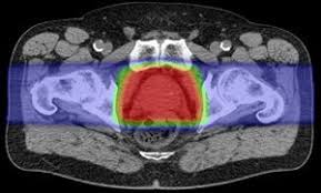 proton therapy for prostate cancer