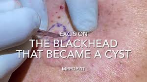 ingrown hair cyst the blackhead that
