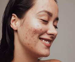 the only way to manage hormonal acne as