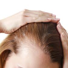 While microneedling revs up collagen production in the scalp just like it does on the face, it also brings blood flow and nutrients to the scalp and induces new stem cells that support hair growth, jay explains. Can Kybella Cause Hair Loss St George Ut