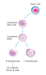 Chronic Lymphocytic Leukemia Wikipedia