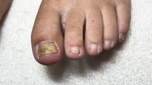 how to help a toenail reattach