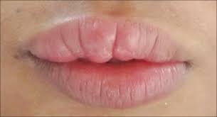 dry lips that is terrible for kissing