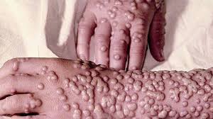 what is smallpox symptoms causes
