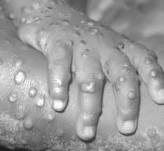 Monkeypox is a rare viral infection transmitted via animals and humans. Monkeypox