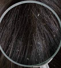 Different Types Of Dandruff And How To Prevent Them