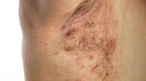 armpit rash 14 possible causes and how