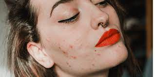 cheek acne causes and treatments