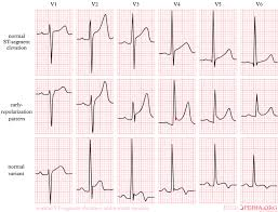 St Elevation Myocardial Infarction Electrocardiogram Wikidoc