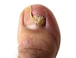 toenail fungus foot doctor
