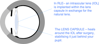 refractive lens exchange rle
