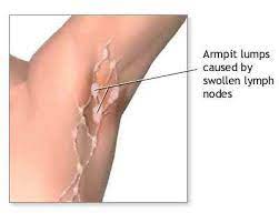 home remes to treat painful armpit lumps