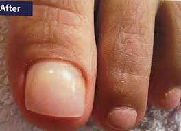 pedique cosmetic toenail replacement