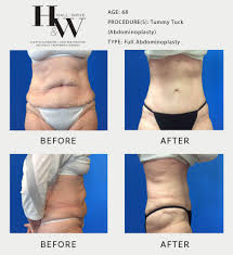liposuction vs tummy tuck hall