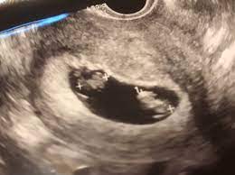 8w1d ②双子復活！ | 42歳 体外受精を経てやっと妊娠したらMDツイン(一卵性双生児)でした