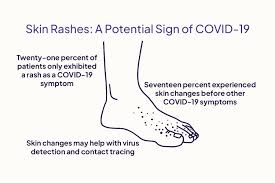 rashes that can be a sign of covid 19