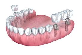 best dental implants clinic cost in