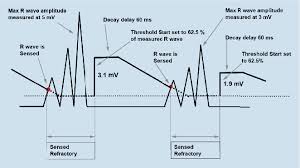 Detection And Discrimination Of Tachycardia In Icds