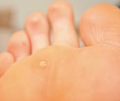 plantar warts treatment options for