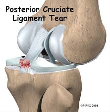 pcl posterior cruciate ligament tear