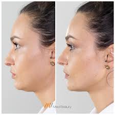 This patient wanted a more defined jawline! Jawline Filler Jawline Augmentation With Dermal Filler M1 Med Beauty