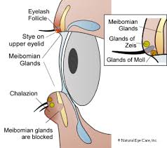 chalazion information from natural eye care