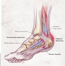 Diagnosis Of Heel Pain American Family Physician