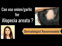 alopecia areata should you use onion